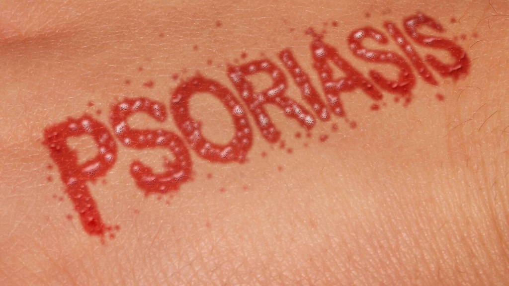 Psoriasis