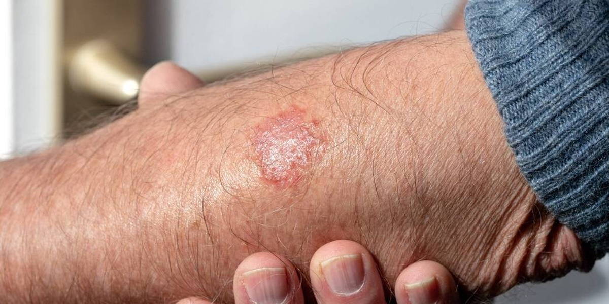 eczema on the arm of a man