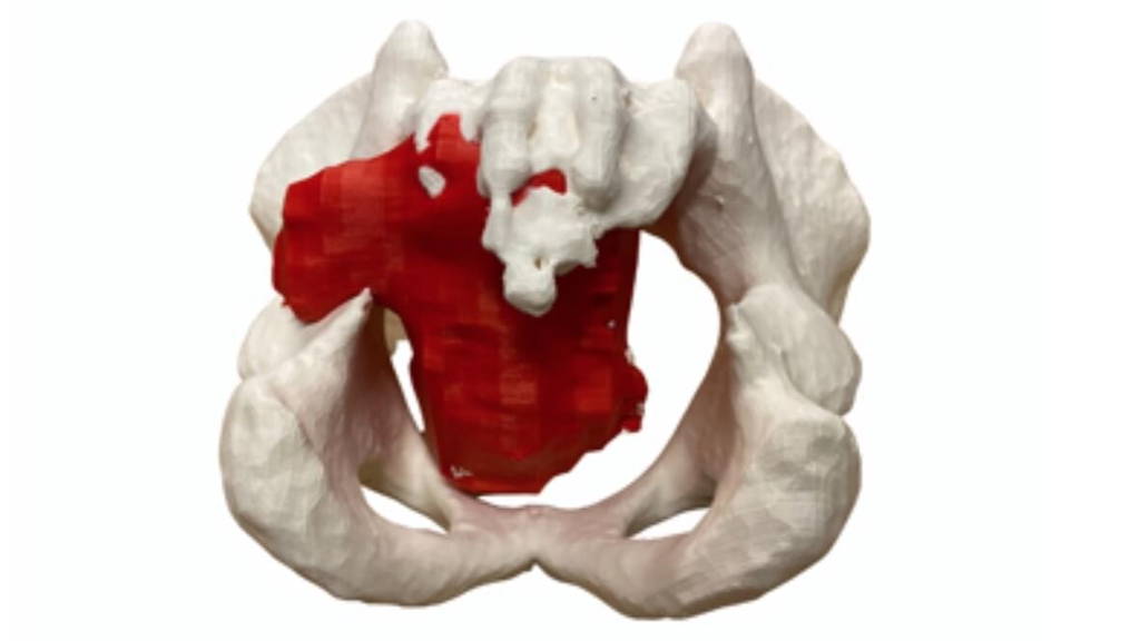 3D-BekkenProthese-LUMC-1