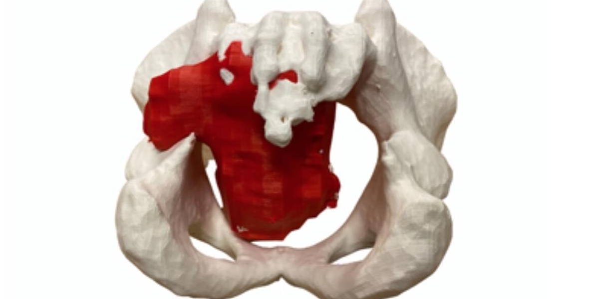 3D-BekkenProthese-LUMC-1