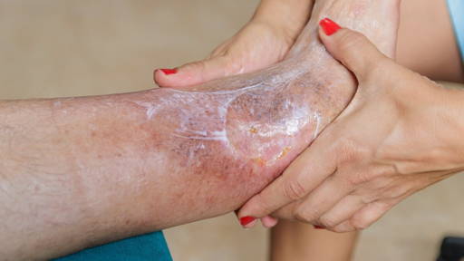 Innovative oxygen gel for healing chronic wounds