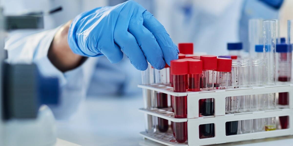 AI blood test improves diagnosis of dementia