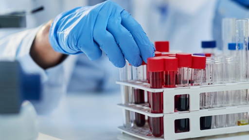 AI blood test improves diagnosis of dementia