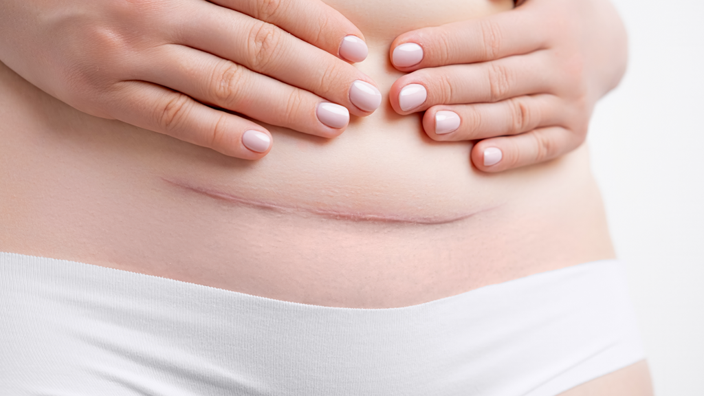 Keizersnede complicaties