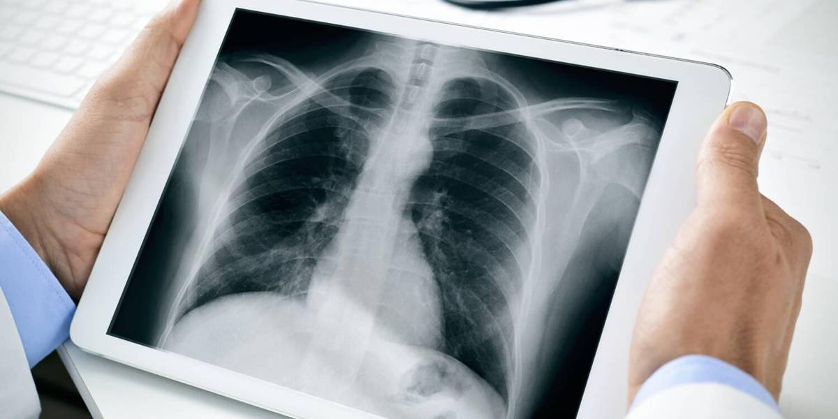 COPD-pilot zorg-op-afstand platform moet heropname voorkomen