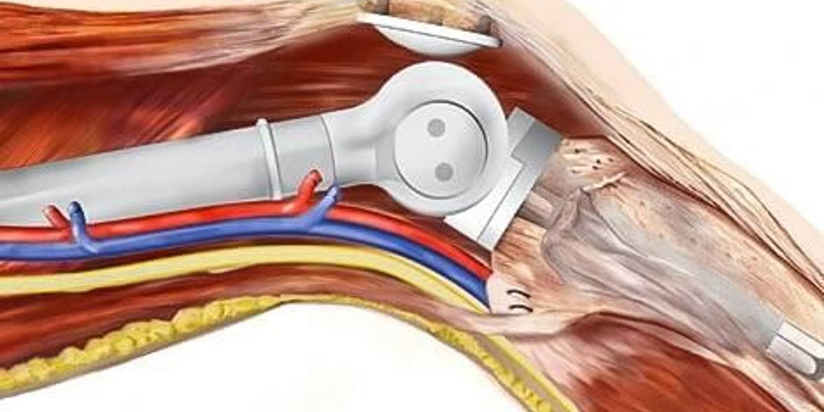 LUMC-verwijderen-bottumoren