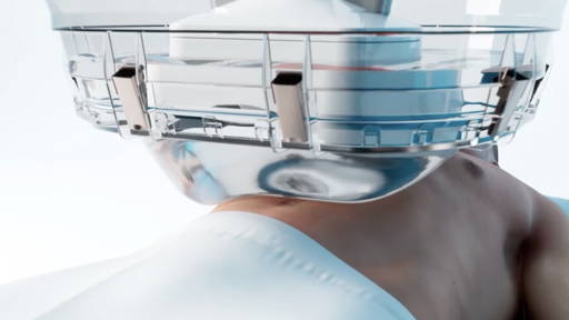 Histotripsy: een stille revolutie in kankerbehandeling