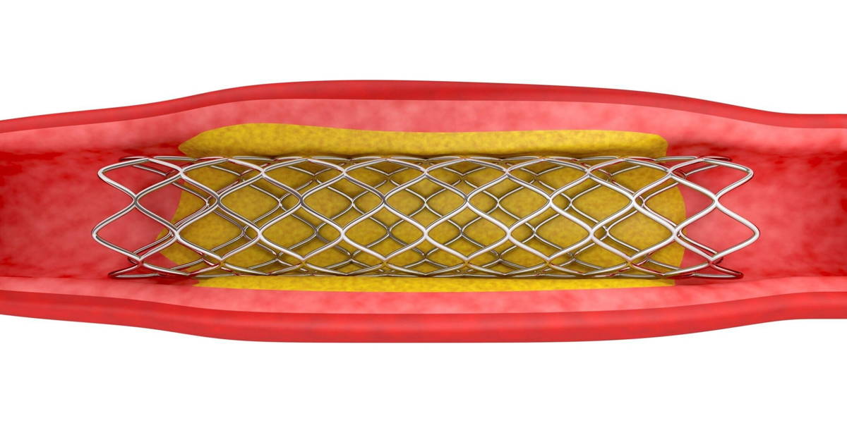 stent-scaled