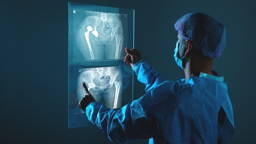 AI predicts recovery and walking ability after hip surgery