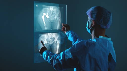 AI predicts recovery and walking ability after hip surgery