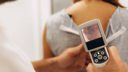 Landelijke databank voor gerichtere behandeling bij huidkanker