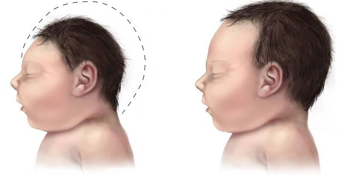 Microcephaly-comparison-500px