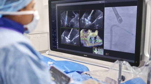 Philips onthult een nieuwe AI-tool voor hartreparaties