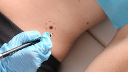 ‘Intelligent Tattoo’ could detect melanoma earlier