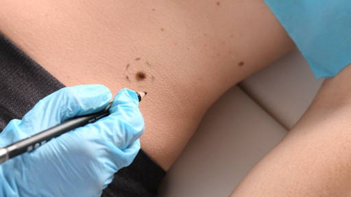‘Intelligent Tattoo’ could detect melanoma earlier
