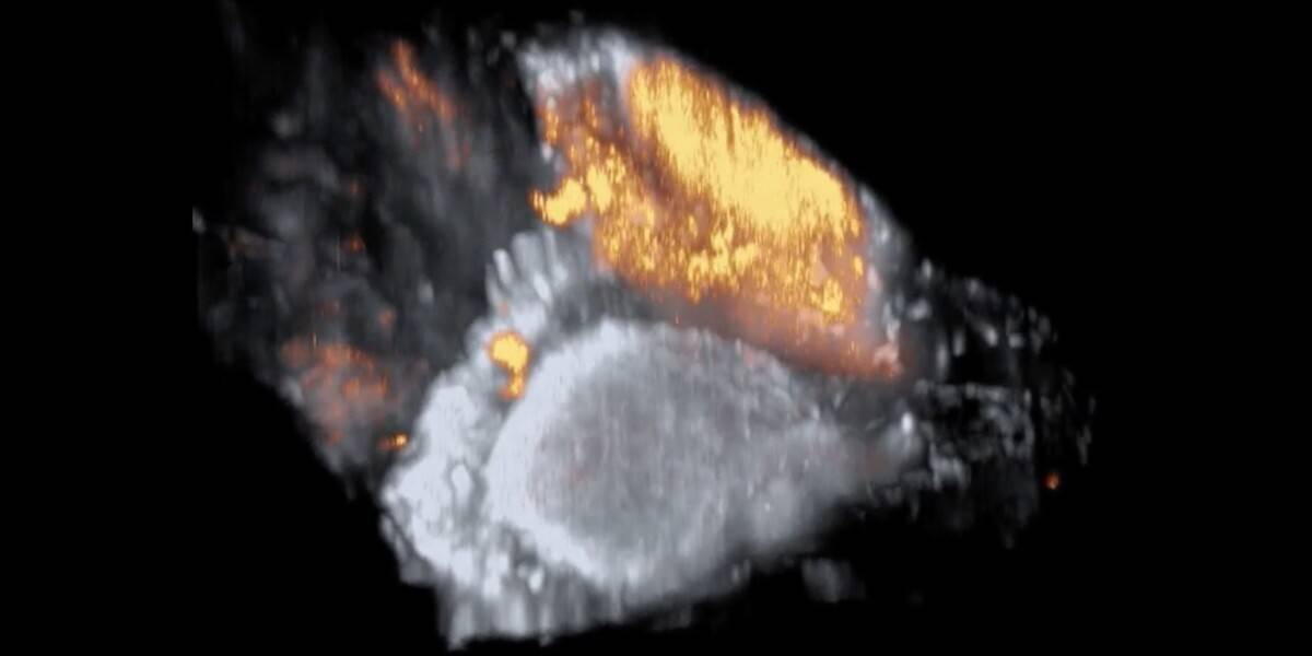 3D-hersenscan Epileptische aanval