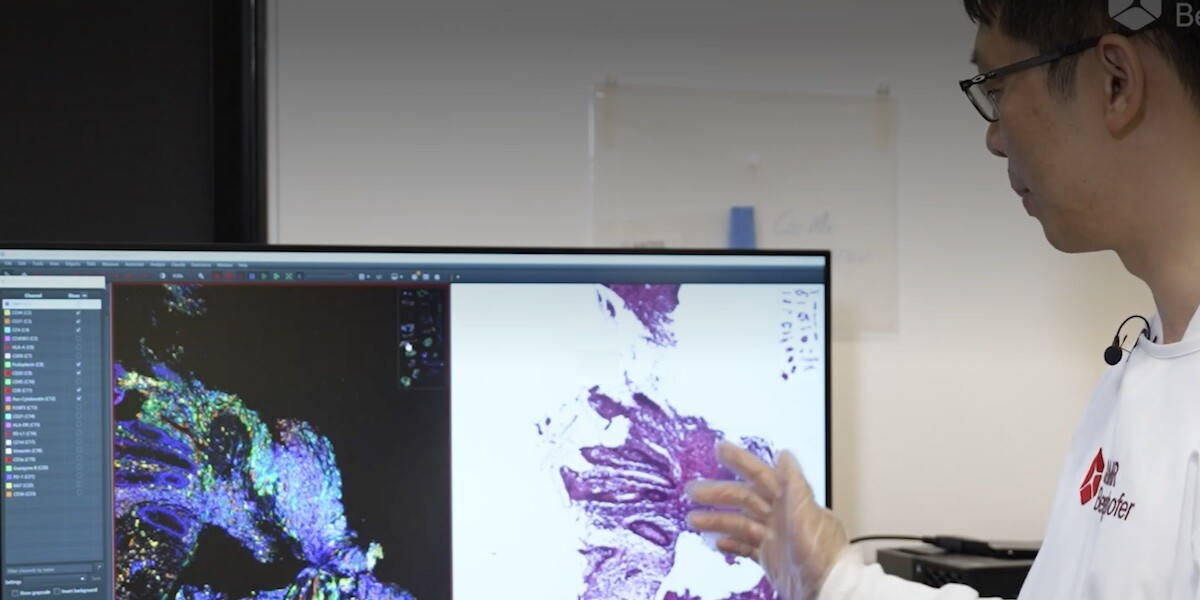 AI geeft pathologen ‘superzicht’ op verborgen kanker
