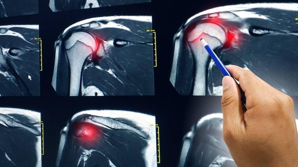 Onderzoek naar geschiktheid gestructureerde verslaglegging MRI Schouder