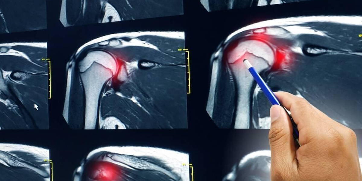 Onderzoek naar geschiktheid gestructureerde verslaglegging MRI Schouder