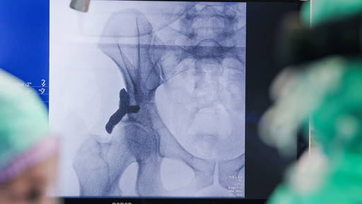 Eerste 3D-geprinte heupimplantaat bij mens geplaatst