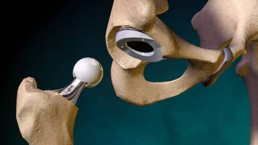 Implant-hip-3-570x360