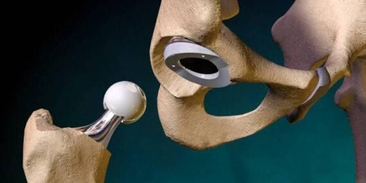 Implant-hip-3-570x360